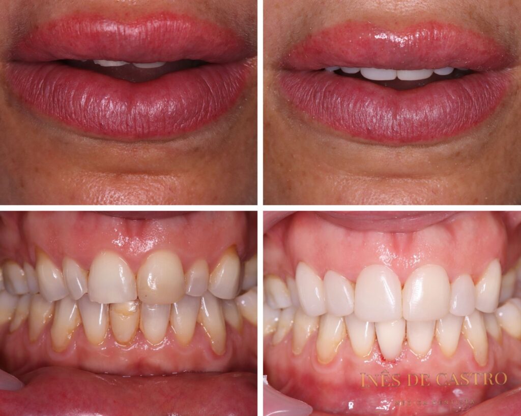 Caso Ortodontia #02 – Alinhamento Dentário