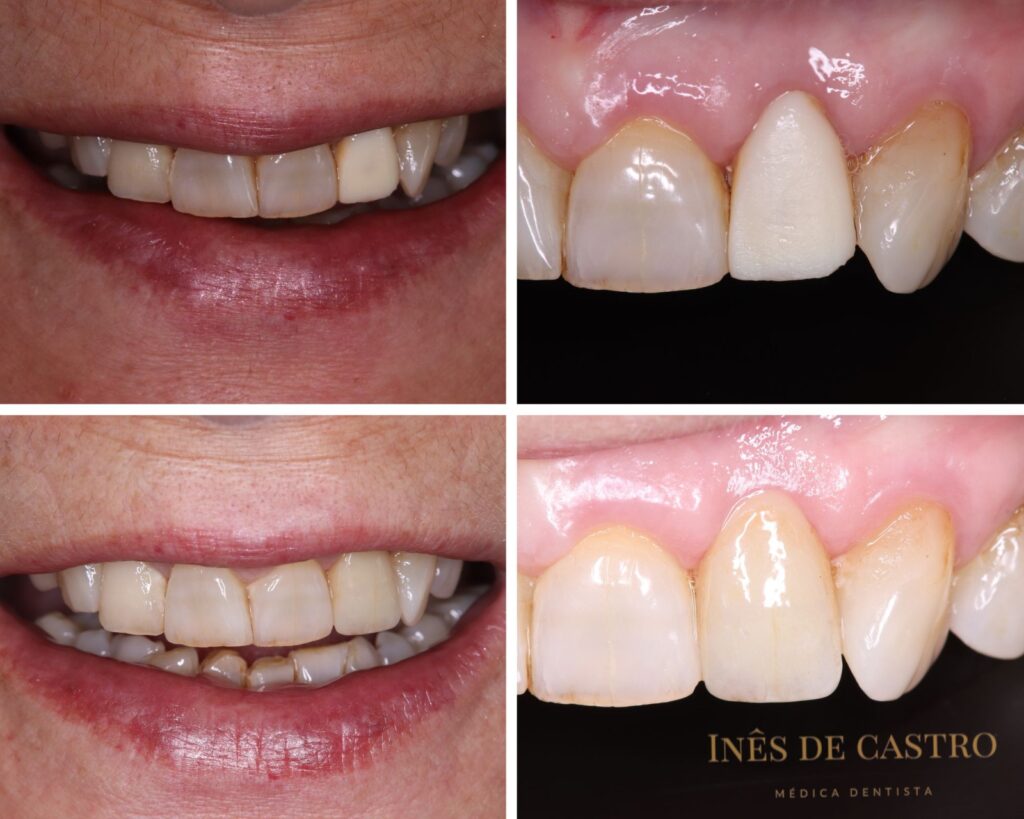 Caso Sorriso #01 – Reabilitação Estética